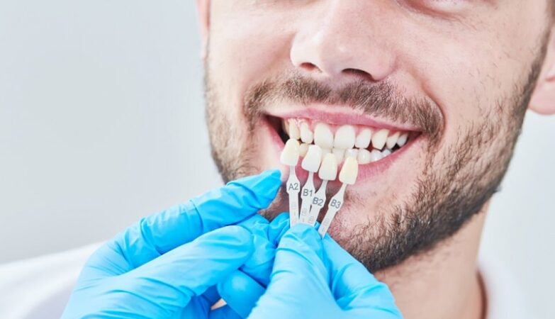 All You Need To Know Before Getting Dental Veneers