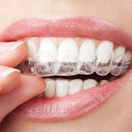 Preparing For Invisible Braces – Essential Steps Before Your Procedure